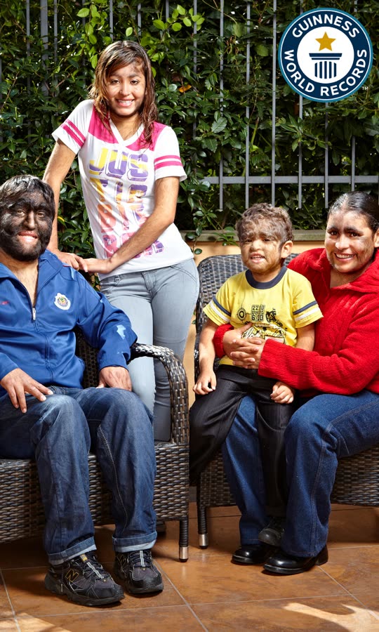 Meet the World's Largest Hairy Family